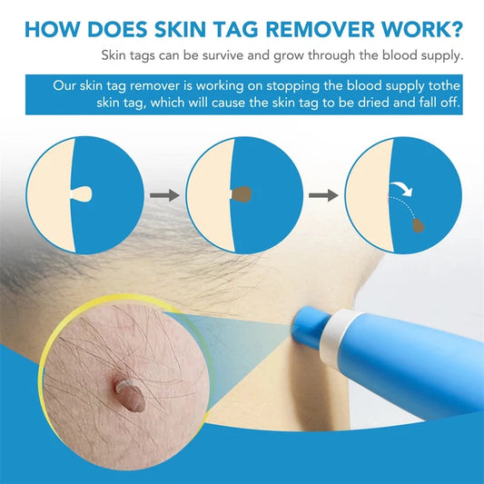 Double Headed Pen Set Auto Skin Tag Remover Kit