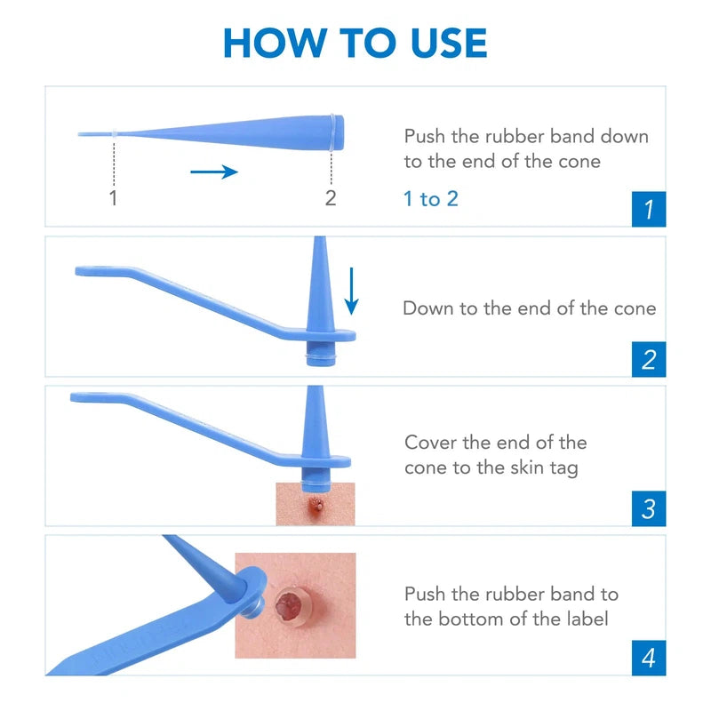 Simple Skin Tag Removal Tool