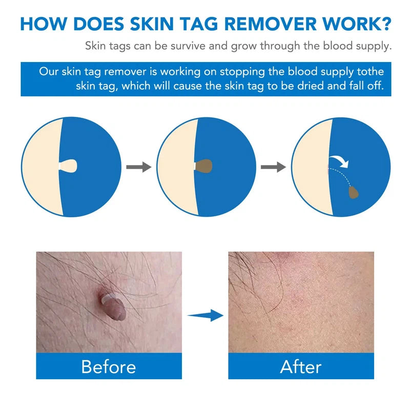Simple Skin Tag Removal Tool