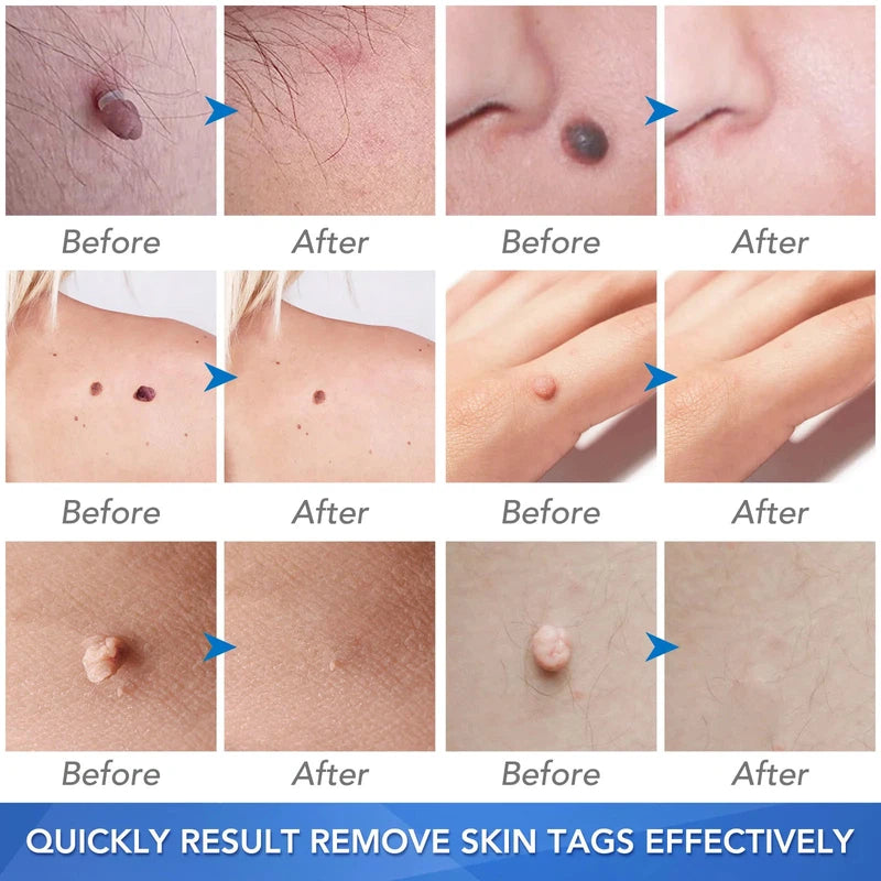 Simple Skin Tag Removal Tool